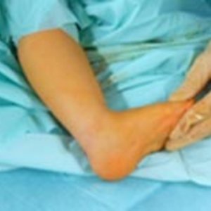 Zustand nach perkutaner Achillessehnentenotomie mit anschießender Oberschenkelgipsanlage