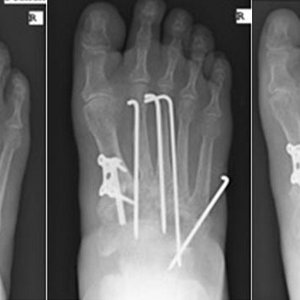 Um die Fußwurzel zu versteifen, werden Schrauben und Drähte eingesetzt, bis die Knochen zusammengewachsen sind. Die Drähte werden später wieder entfernt.